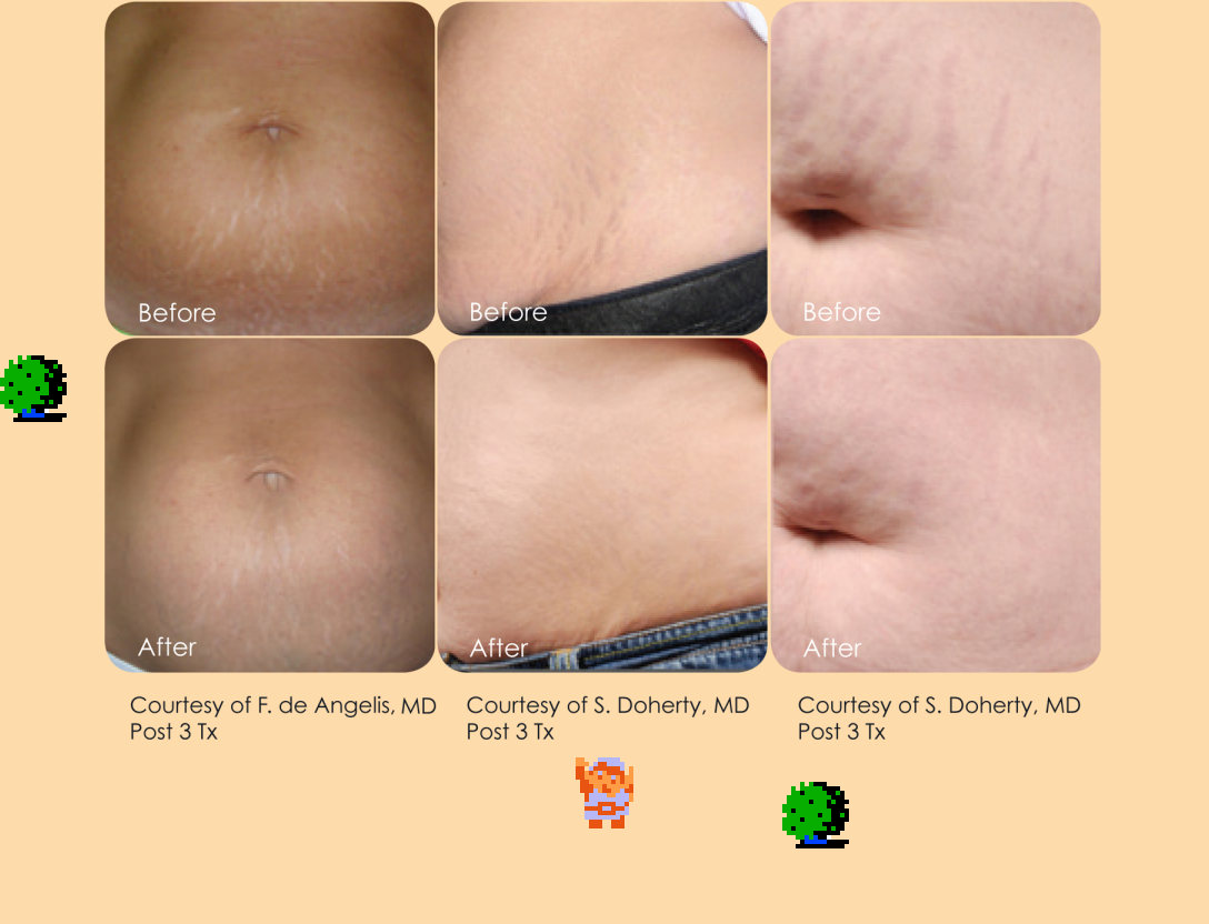 ♪ DOO DOO DOO DOO! ♪ (C-sections)