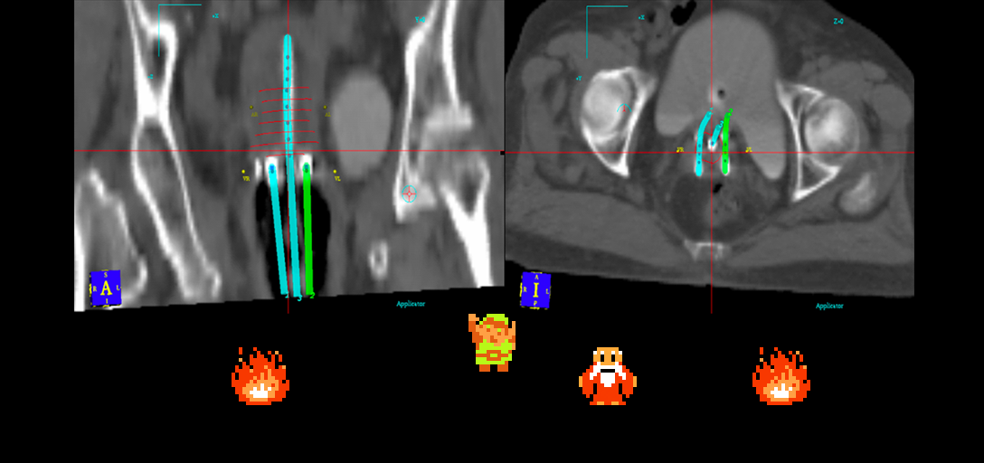 ♫ DOO DOO DOO DOO! ♩ (brachytherapy)