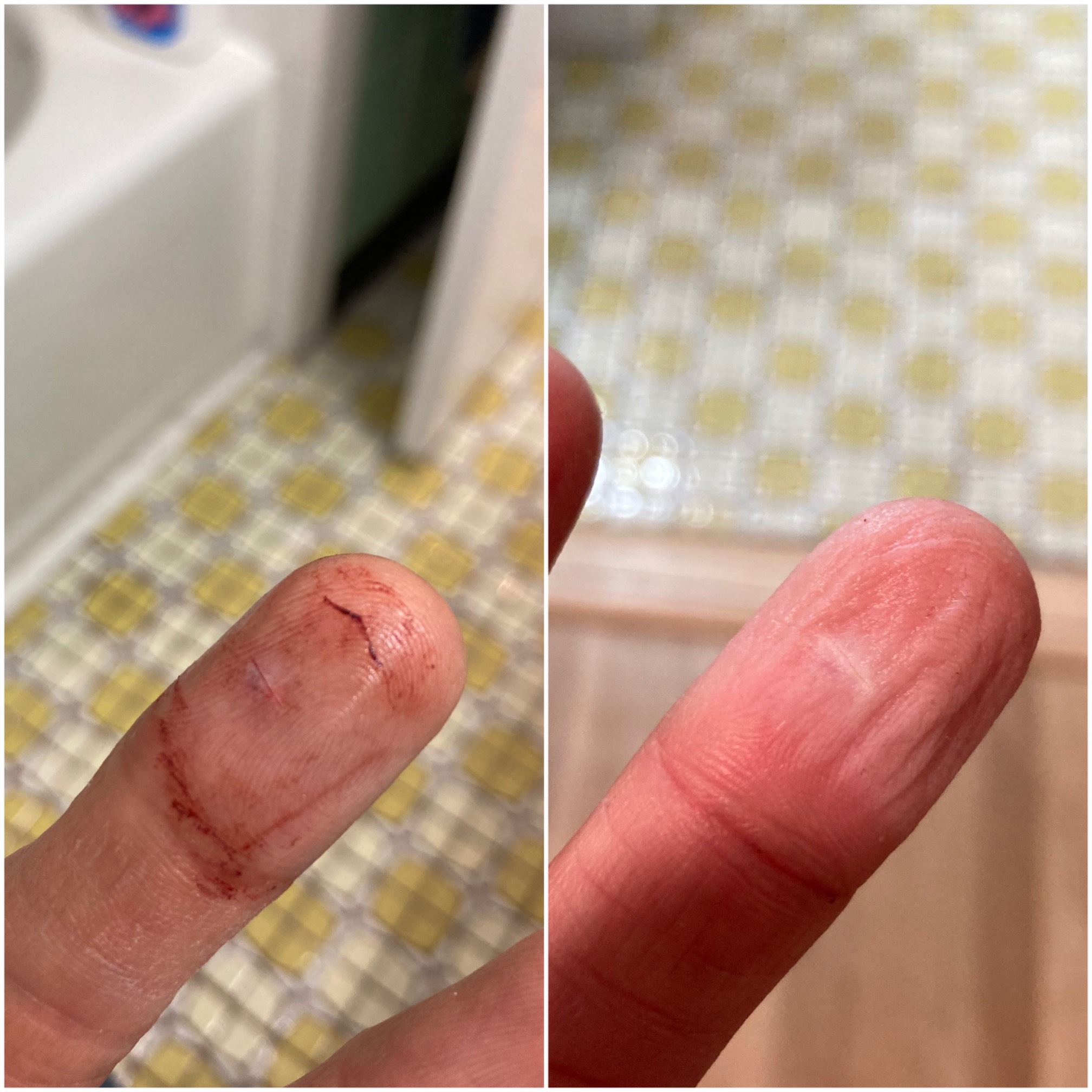 (Content warning: bloody finger.)Just one day of healing can do a lot for you!