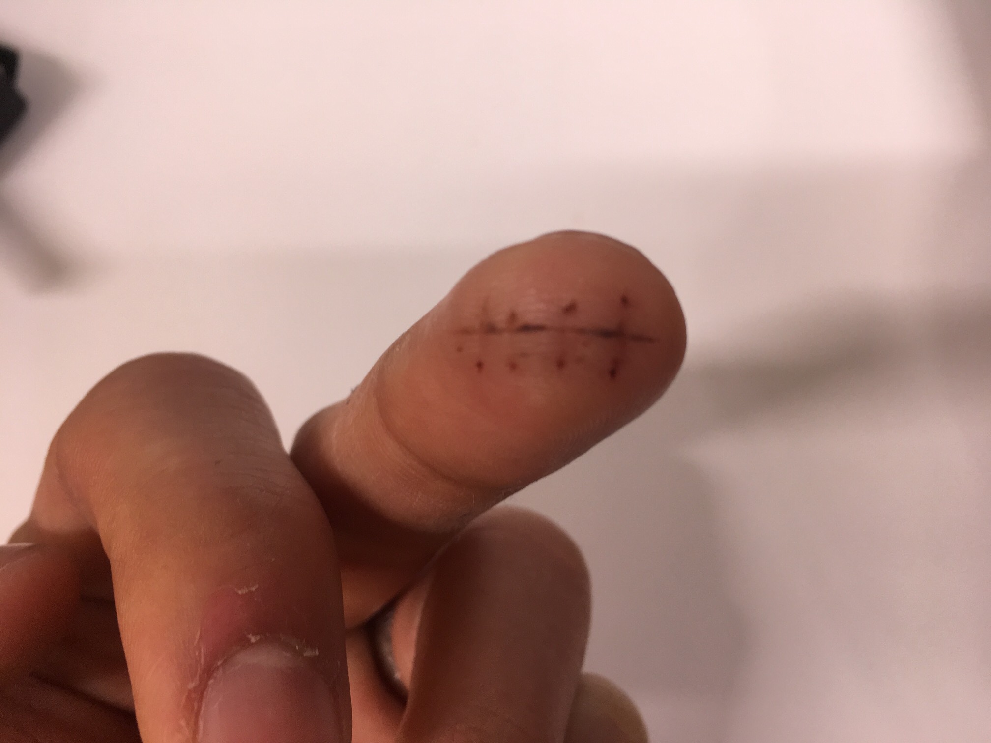 Stitches out!